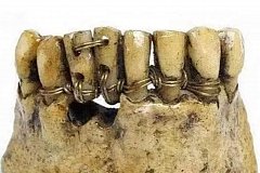 Как «древние люди» протезировали зубы?