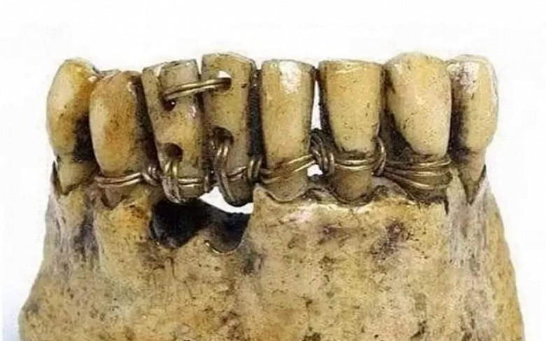 В Древнем Риме зубные протезы изготавливали из костей животных и скрепляли их золотыми проволоками